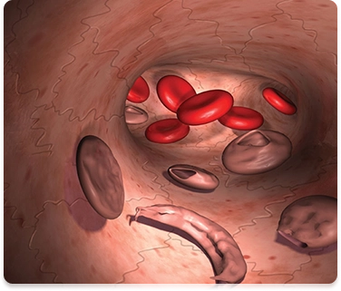 Anemia Illustration