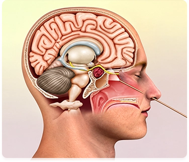 Enodscopic Endonasal