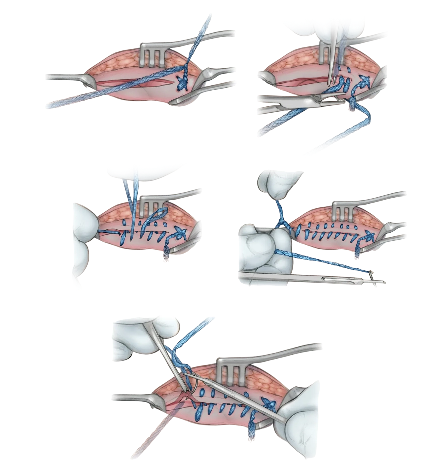 Procedure Steps